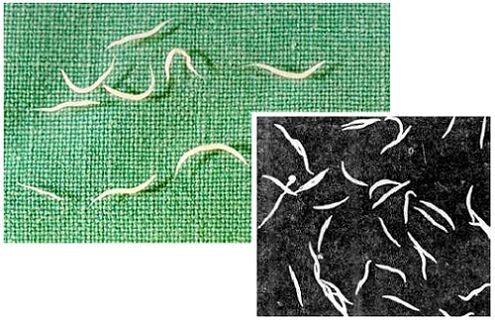 needleworms from the human body