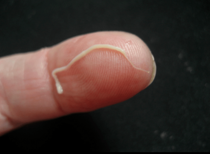 roundworm parasite from the human body